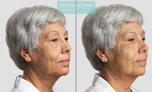 Threadlift mid face lift jawline women before after photo london results 087TPC