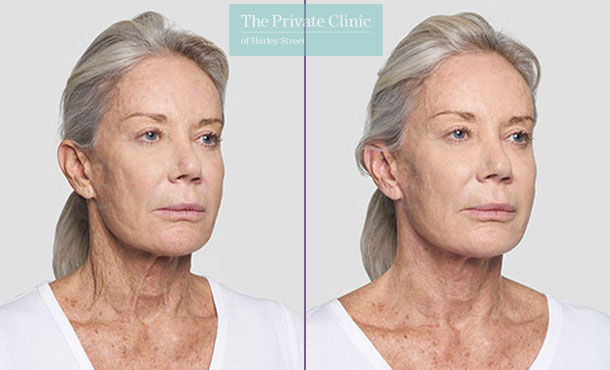 Threadlift neck lift uk before after photo results 088TPC