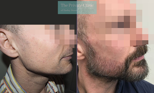 Beard Transplant London | Facial Hair transplants UK | Mens Beard hair  growth