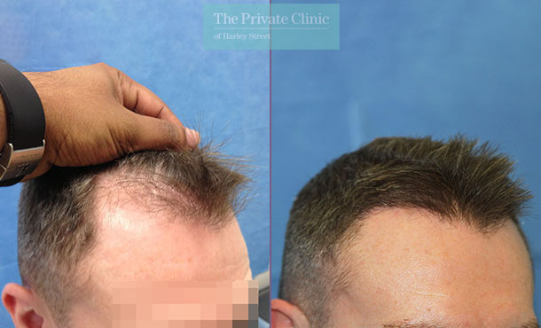 FUE Hair Transplant - 094RR