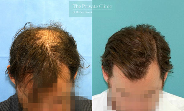 FUE Hair Transplant -124RR