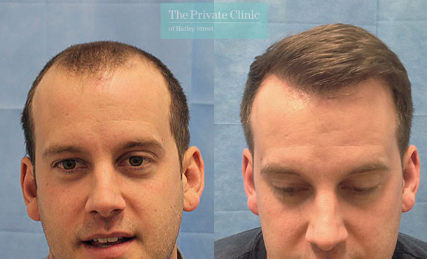 FUE Hair Transplant - 069RR-Front