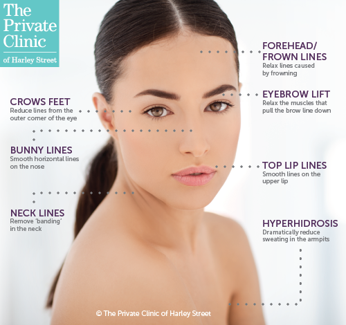 botox face injection best areas sites