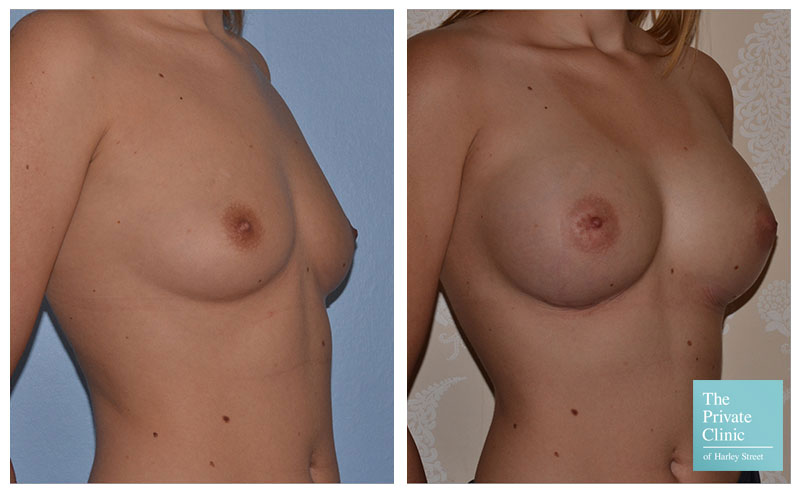 breast augmentation enlargement implants before and after photos 001