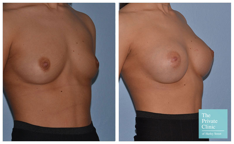 breast augmentation enlargement implants before and after photos 002