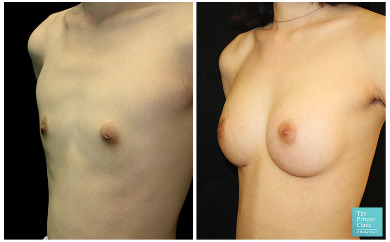 breast augmentation enlargement implants before and after photos 003