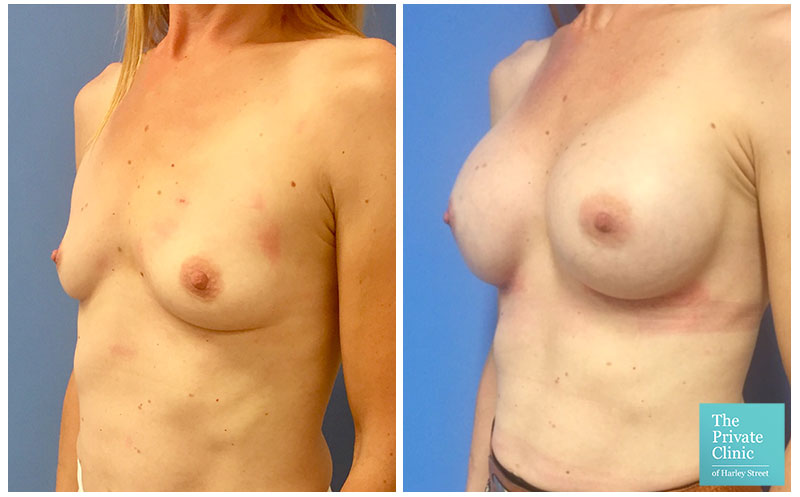 breast augmentation enlargement implants before and after photos 004