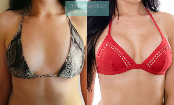 Breast Augmentation -001LF-Front