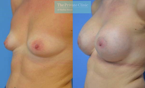 Breast Augmentation - 001AF-Side