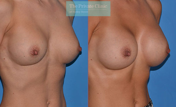 Breast Implant Removal Replacement - 065AR-RR-Side