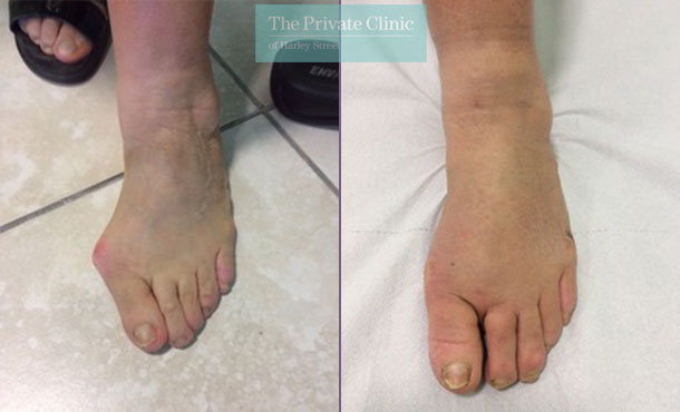 bunion minimally invasive surgery uk before after photos dr andrea bianchi 007AB