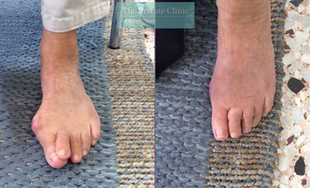 bunion removal london minimally invasive surgery before after results photos dr andrea bianchi 008AB