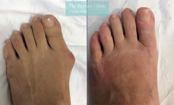 bunion removal reduction minimally invasive kehole surgery london before after results photos dr andrea bianchi 006AB