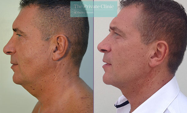 chin neck liposuction men before after photos