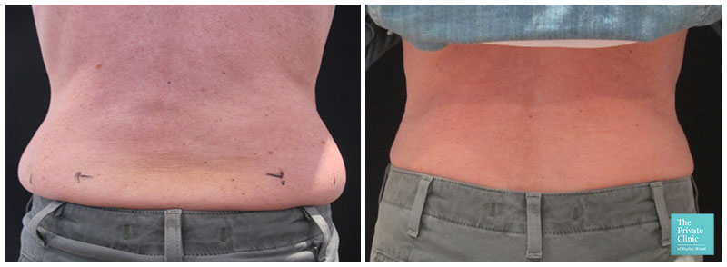 coolsculpting fat freezing crylipolysis hips flanks sides love handles before after results 2