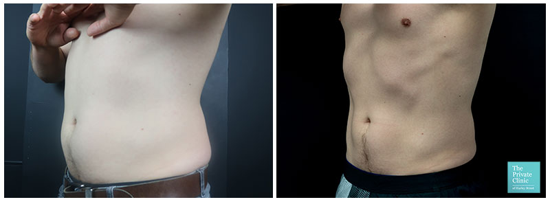 coolsculpting fat freezing crylipolysis male abdomen chest tummy before after results
