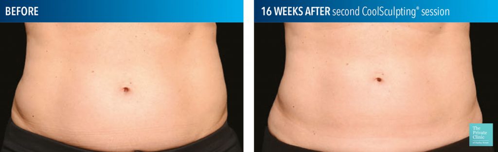 coolsculpting fat freezing results before after photos abdomen tummy stomach bristol 1024x313 1