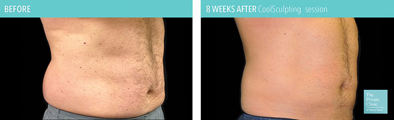 coolsculpting fat freezing results before after photos flanks and tummy manchester 2