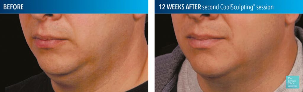 coolsculpting fat freezing results before after photos submental chin 013 1024x314 1