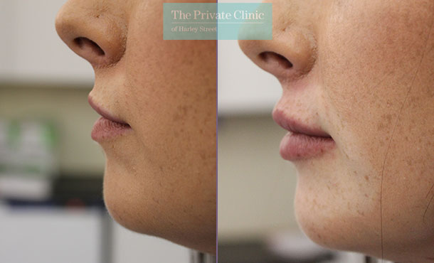 Dermal Filler - Lips - 003SC - side