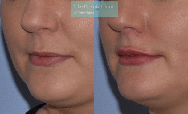 dermal fillers plump lips before after results photos london mel recchia 005MR