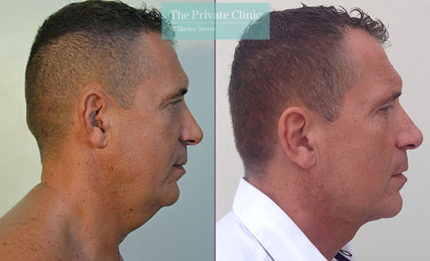 double chin reduction liposuction micro lipo fat removal before after photos results mr roberto uccellini side2 007RU