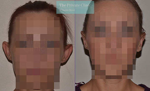 ear correction surgery otoplasty before after photo london results front 015TPC