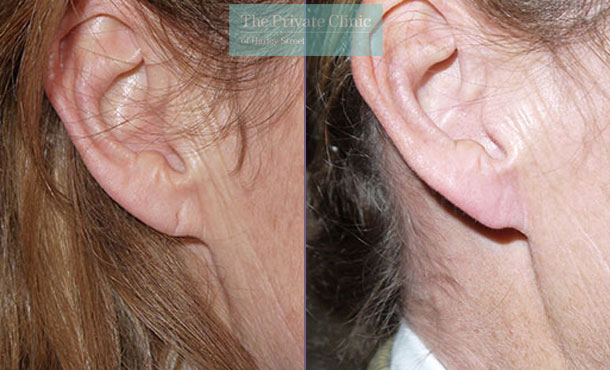 earlobe repair surgery before after photo results uk mr miles berry 014MB