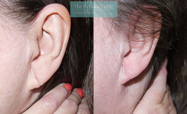 Split Earlobe Repair - 013MB