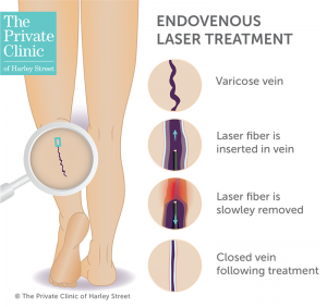 endovenous laser ablation evla treatment varicose veins insurance cost self pay 300x282 1