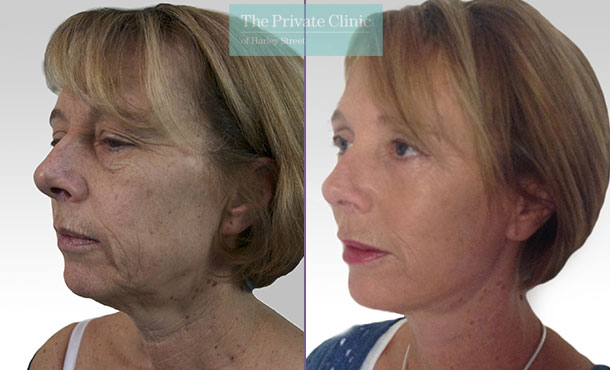 facelift face lift surgery rhytidectomy before after photo results mr roberto uccellini angle 012RU