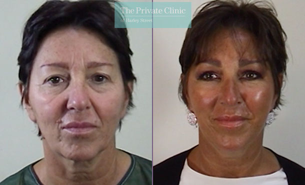 facelift surgical face lift surgery before after photos results mr roberto uccellini 014RU