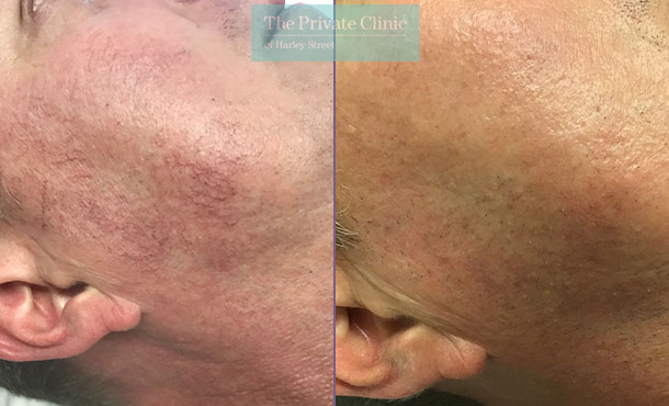 facial thread veins before after photo results 001SS