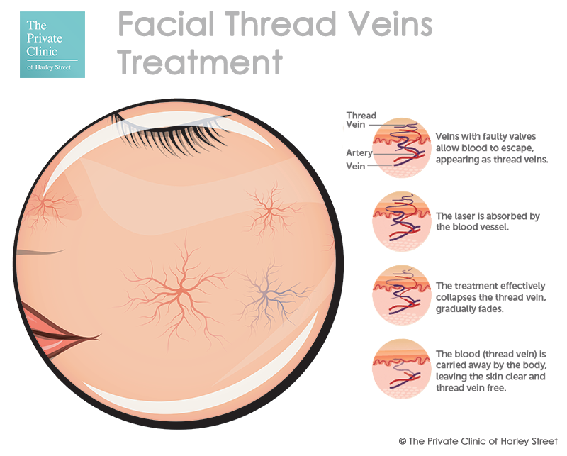 facial veins treatment thread veins face cutera coolglide ndyag laser treatment web