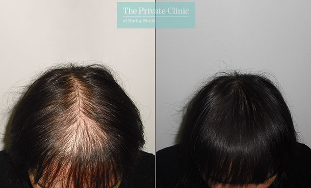 female fue hair transplant before after photo london results dr luca de fazio 009LDF