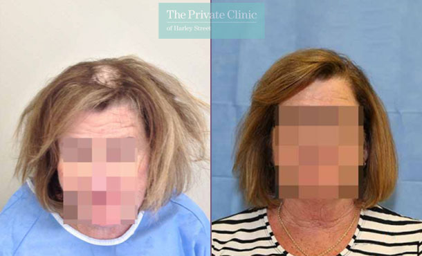 FUE Hair Transplant for Women - 010RR-Front