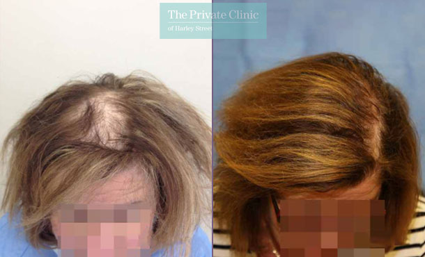 FUE Hair Transplant for Women - 010RR-Crown