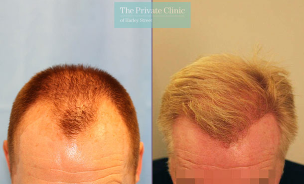 FUE Hair Transplant - 067RR