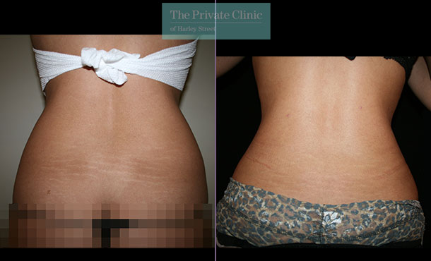before and after photo of vaser lipo