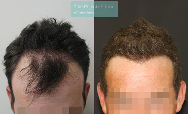 FUE Hair Transplant - 013RR-Front