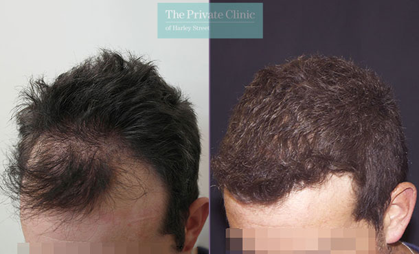 FUE Hair Transplant - 013RR-Side