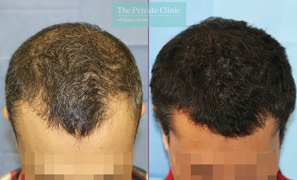 FUE Hair Transplant - 095RR-Front