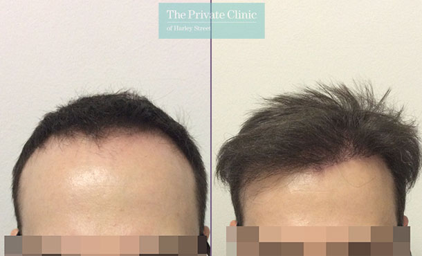 follicular unit extraction hair transplant before after photo results dr luca de fazio 005LDF