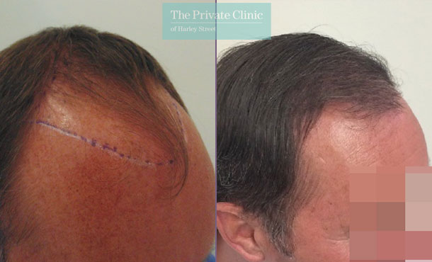 follicular unit extraction hair transplant before after photo results mr michael mouzakis side 005MM