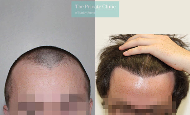 FUE Hair Transplant - 033RR