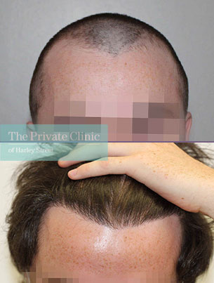 follicular unit transplantation fue hair transplant before after results london dr raghu reddy 033RR follicular unit transplantation fue hair transplant before after results london dr raghu reddy 033RR