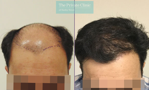 follicular unit transplantation fue hair transplant before after results mr michael mouzakis 019MM