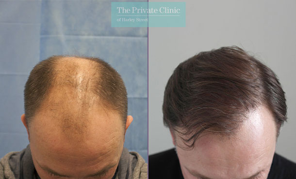 FUE Hair Transplant - 068RR