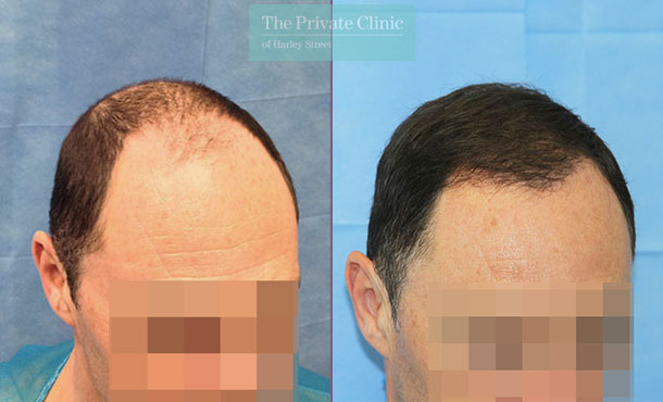 FUE Hair Transplant -100RR-Side