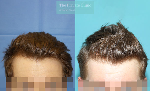 FUE Hair Transplant - 014RR